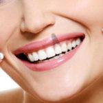 implants | Centre Dental Cise